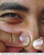 Image - Squeezing blackheads.jpg - Uncyclopedia, the content-free ...