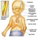 Signs of <b>Progeria</b>