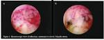 File:Hysteroscopy of Asherman's Syndrome.jpg - Wikipedia, the free ...