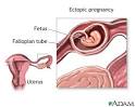 Staying healthy during pregnancy - Ectopic Pregnancy