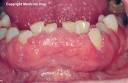 1.11: <b>Hiperplasia</b> gingival por