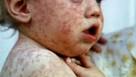 health-0326-measles-640x360.jpg