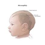When a child has <b>microcephaly</b>,