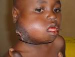 File:Large facial Burkitt's Lymphoma.JPG - Wikipedia, the free ...