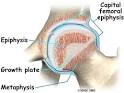 A Patient's Guide to Slipped Capital Femoral <b>Epiphysis</b>