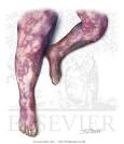 Disseminated Intravascular Coagulation (DIC) in Fulminant ...