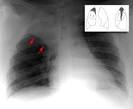 Right middle lobe <b>atelectasis</b>