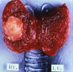 papillary-<b>thyroid</b>-<b>carcinoma</b>.jpg