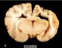 L'<b>encefalite</b> riconosce cause