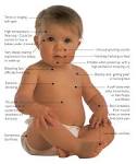 Meningitis Symptoms In Babies