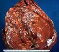X-ray, image, picture, photograph, cancer, carcinoma, tumor ...
