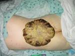 Massive nodular melanoma: A case report