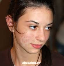 acne severo