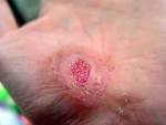 http://upload.wikimedia.org/wikipedia/commons/2/23/Hand_Abrasion_-_13_days_15_hours_30_minutes_after_injury.JPG