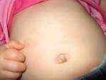 What does <b>Exanthem Subitum</b>