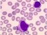 syndrome_mononucleosique.png