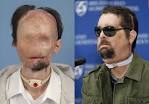 First U.S. Face Transplant