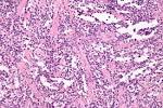 File:Alveolar <b>rhabdomyosarcoma</b>