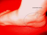 <b>Dyskinesi</b>, medel mot. Dyskinesi, medel mot www.lookfordiagnosis.com