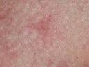 Telangiectasia macularis eruptiva perstans