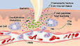 La <b>inflamación</b> puede ser