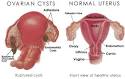 Ovarian Cysts | Female Alternative Surgery