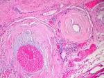 File:Amyloidosis, blood vessels, H&amp;E.jpg - Wikipedia, the free ...