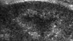 Medullary <b>nephrocalcinosis</b>.