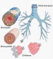 EPOC (Enfermedad Pulmonar Obstructiva Crónica).