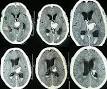 Cerebral hemorrhage - Wikipedia, the free encyclopedia