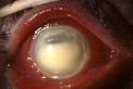 plutôt une <b>endophtalmie</b>