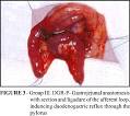 <b>duodenogastric reflux</b>