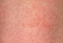 Exquisitely contagious" Measles Case Infects Small Child In Clark ... 