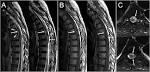 the <b>hematoma</b> is <b>subdural</b>