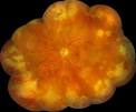 <b>Acute retinal necrosis</b> www.sciencedirect.com