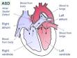 <b>Atrial septal defect</b> - Wikipedia, the free encyclopedia