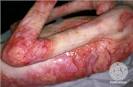 Epidermolysis Bullosa