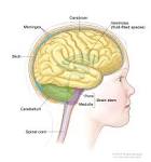Most childhood brain stem