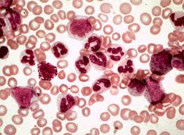 The protein interleukin-27. Fundamental discovery for the leukemia