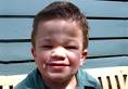 Hunter Syndrome | SRxA's Word on Health