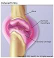 Who Gets <b>Osteoarthritis</b>?