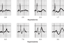 <b>HYPOKALEMIA</b> RISK FACTOR