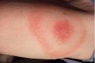 3 Ways to Recognize LYME DISEASE Symptoms - wikiHow