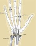 <b>Joint</b> Replacement
