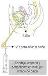 <b>CATETERISMO</b> VESICAL EN LA MUJER | CORPORACION ACCION MUJER