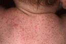 Roseola | Roseola Infantum | Roseola Rash | Roseola Pictures ...