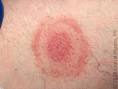 How to Recognize LYME DISEASE SYMPTOMS - InfoBarrel