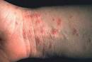<b>scabies</b>
