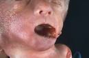 TRISOMY 18