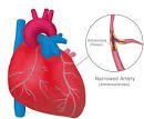 HSD / Patients &amp; Carers / Heart Disease / What is Coronary Heart ...